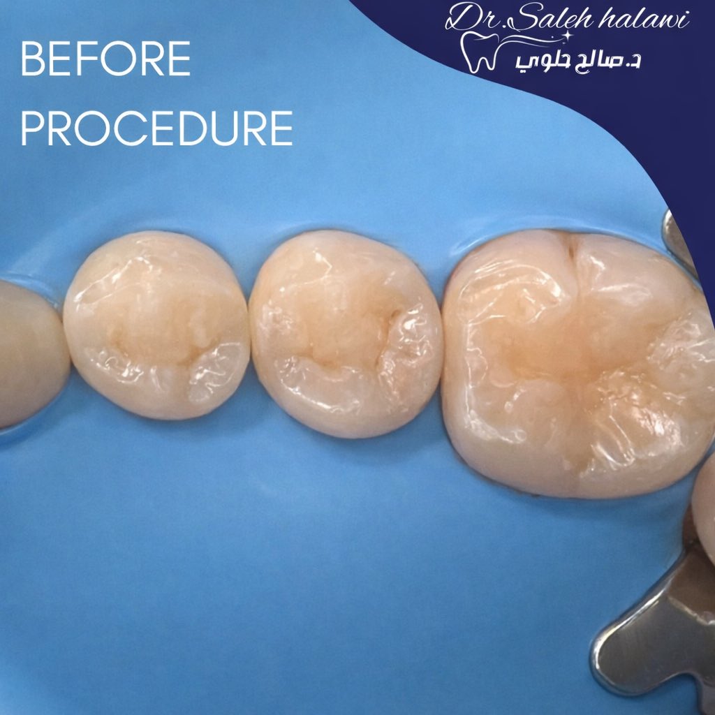 Class II composite restoration under rubber isolation, second CE IS DONE.✅ 

#operative #dentistry