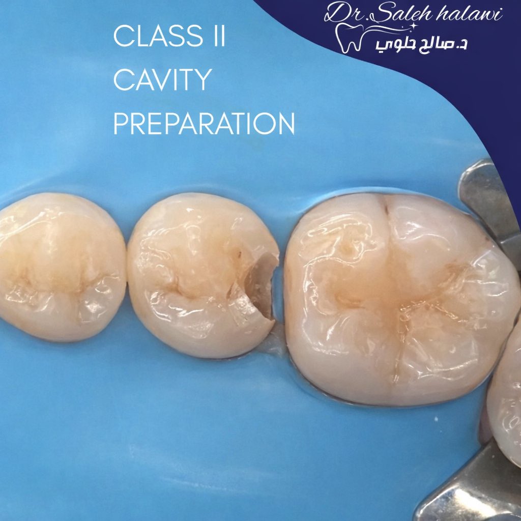 slo_s24's tweet photo. Class II composite restoration under rubber isolation, second CE IS DONE.✅
#operative #dentistry https://t.co/fLABcYByq9