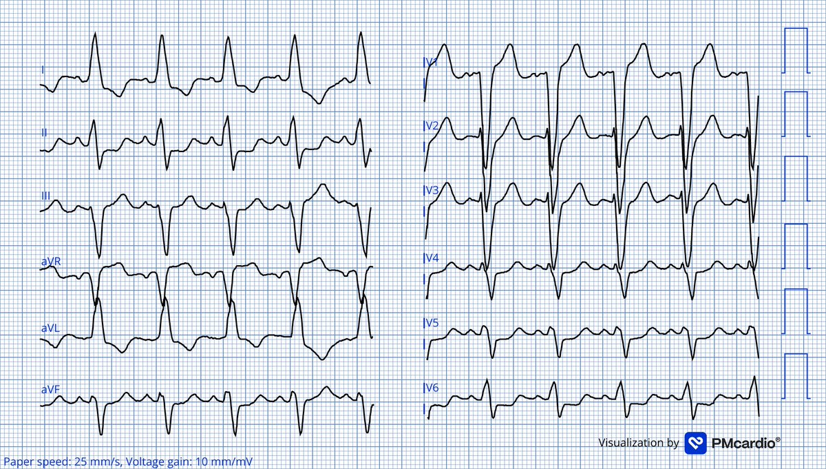 65 y/o F with palpitations
Right Ecg after 12mg Adenosine
Likely Dx?
<a href="/KostekMilan/">Milan Koštek</a> <a href="/Frances98392343/">Cciari1</a> <a href="/Amhar_47/">Amhar Iqbal</a> <a href="/LeonrMail/">Leon</a> <a href="/IBBI_2501/">Muhammad Ibrahim</a> <a href="/IrmaMDv/">Irma</a> <a href="/koggelnoggel/">Jana Borucka</a> <a href="/Jagdish26039718/">Jagdish Singh</a> 

#ecg #ekg #cardioX #cardiotwitter