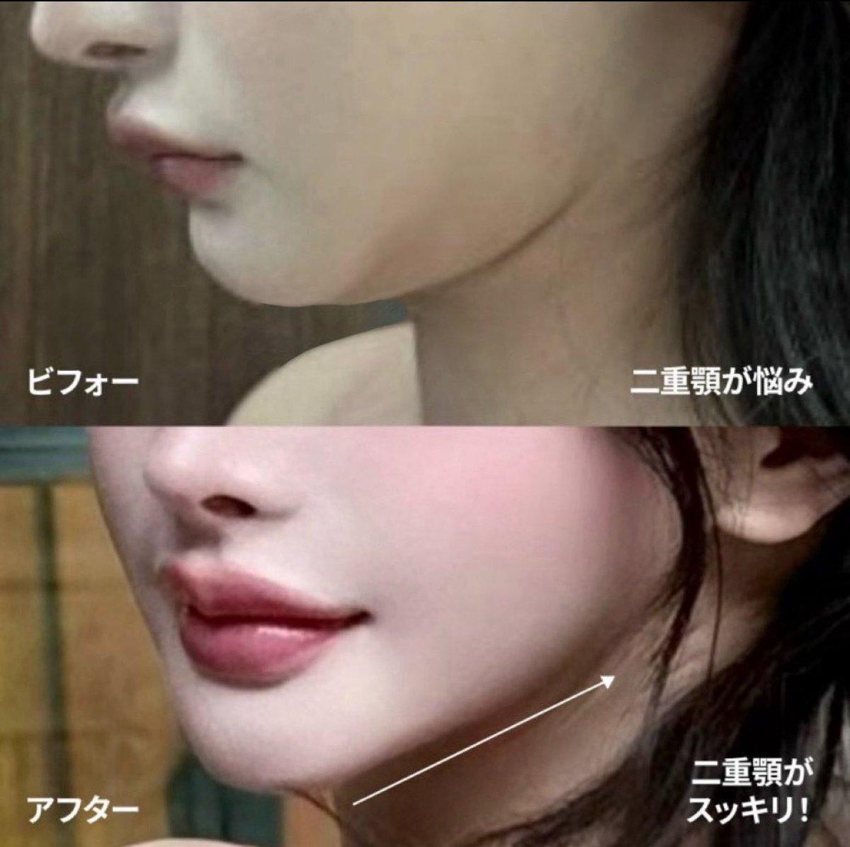 omg989800182918's tweet photo. ギリン美容外科で
顔の脂肪移植・腕の脂肪吸引・ペリカン手術を受けて3ヶ月。
全体のバランスを見ながら自然に整えていただき、印象がとても柔らかくなりました。
腕の脂肪吸引も変化が分かりやすく大満足です。

#ギリン美容外科 #脂肪吸引 #脂肪移植 https://t.co/5y8yDb8P9L
