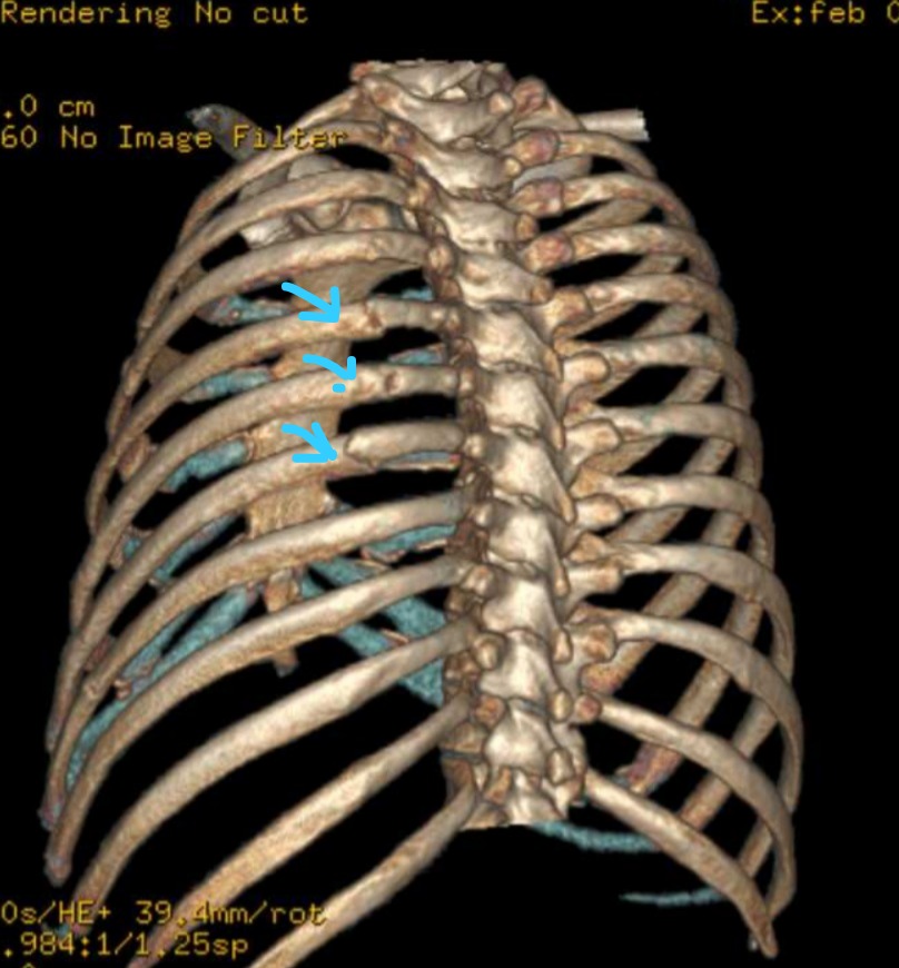 Es lanprimera vez que me animo  a subir fotos sin ropa, si tienen éxito quizás abra una página azul. 
(Acá estoy luciendo mis 8 fracturas lpm)