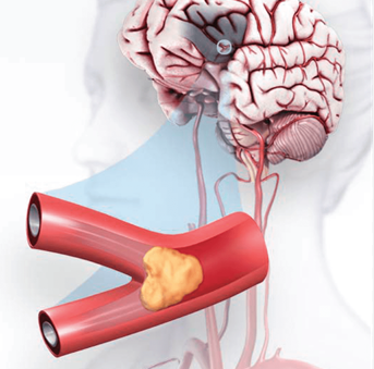 ISICEM's tweet photo. #ISICEM Critical Care Input
2026 Guideline for the Early Management of
Patients With Acute Ischemic Stroke: A Guideline
From the American Heart Association/American
Stroke Association
https://t.co/5fENbdquSn

#ISICEMelearning https://t.co/POKj12ryer