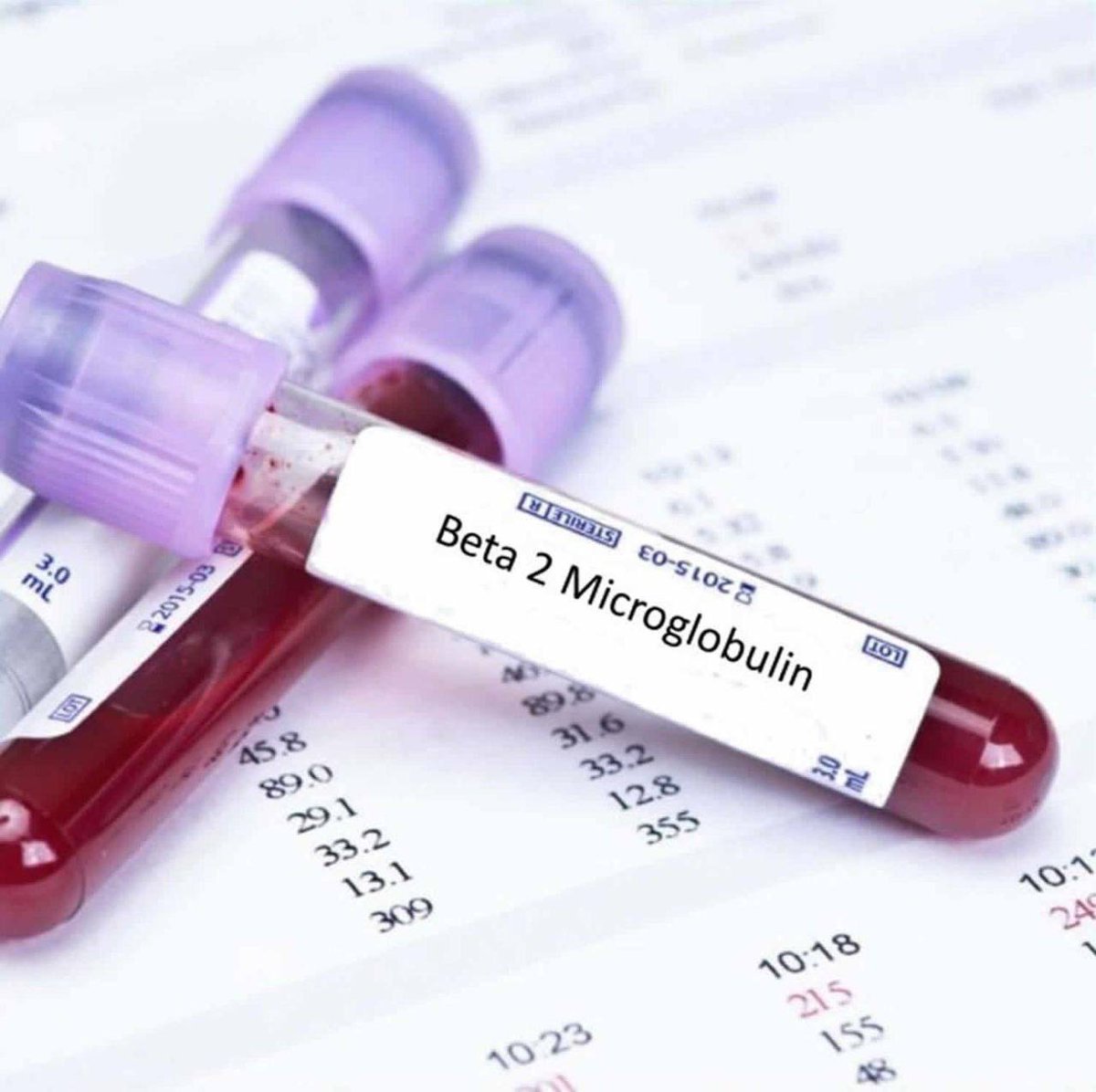 AliAl_khalifah's tweet image. ⭕️تحليل :

B2 Microglobulin
لماذا يجب القيام بهذا الفحص؟
• للمساعدة في تقييم شدة الميلومة المتعددة(Multiple Myeloma) ، أو سرطان الدم، أو سرطان الغدد الليمفاوية
• للتمييز بين اضطرابات الكلى
• للكشف عن الفشل الكلوي
                🔹🔹🔹
متى يجب القيام بهذا الفحص؟
• عند تشخيص…