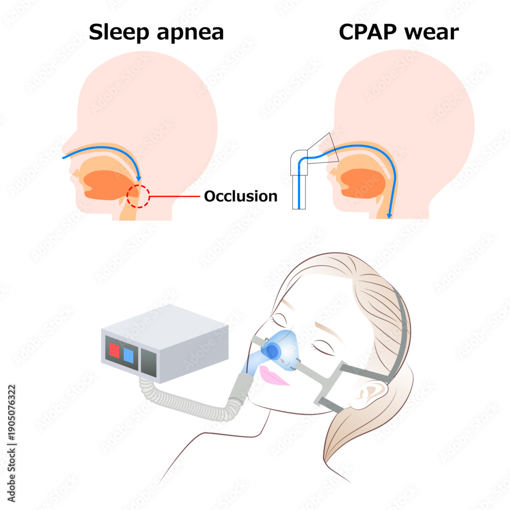 Continuous positive airway pressure (COAP) during sleepのイラストです。
英語版です。
どうぞよろしくお願いします。
ダウンロード→stock.adobe.com/jp/stock-photo…