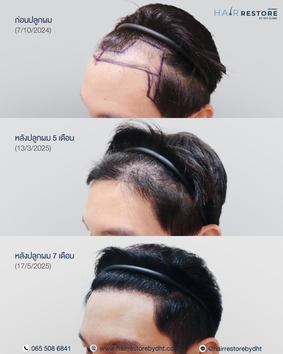 dhtluxclinic's tweet photo. #AdvanceFUT Hair Transplant — boost your confidence with soft and a natural hairline designed just for you ✨
.
📍 #HairRestorebyDHTClinic — We design a personalized hairline that enhances your natural features, ensuring long-lasting, natural-looking results. https://t.co/pYD8oVf9eQ