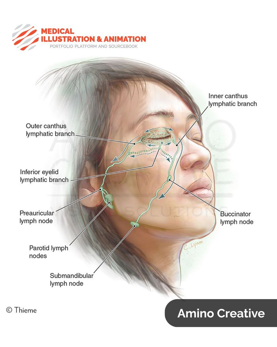 Medillustrates's tweet photo. This illustration by Amino Creative is part of a broader series depicting the anatomy, fluid dynamics, and clinical considerations involved in lymphedema management.
Explore more: https://t.co/eQUKGGsxrD
#medicalillustration #lymphedema #lymphaticsystem #anatomy https://t.co/W0S8s6Rdjb