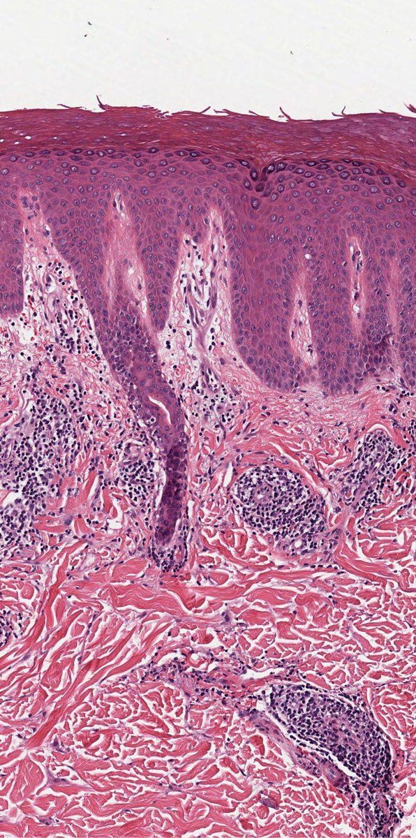 DrCycloPath's tweet photo. ❌ Perniosis
-Superficial and deep perivascular lymphocytic infiltrate
-Aggregates around eccrine glands (peri-eccrine)
-Marked papillary dermal edema https://t.co/DA8nFIVi9E