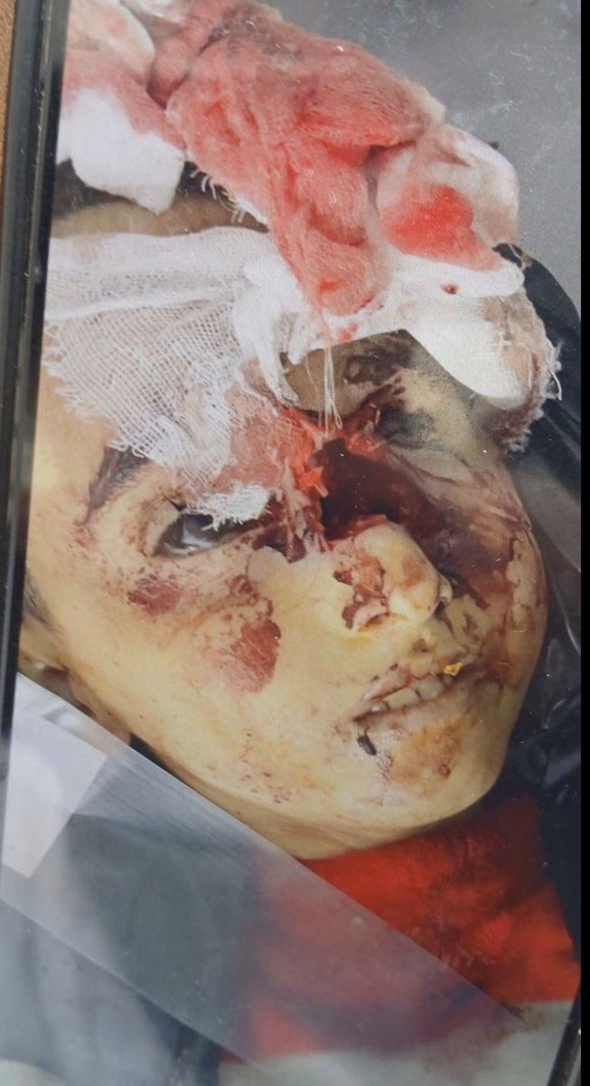 5ogand's tweet photo. Der zwölfjährige #Taha_Houshyar  aus Boumehen, Teheran, wurde am 9. Januar 2026 von den Sicherheitskräften des islamischen Regimes im Iran erschossen, weil er an regimekritischen Protesten teilgenommen hatte.

Mitglieder der Basij-Paramilitärkräfte der IRGC setzten eine Schrotflinte ein und schossen direkt auf sein Gesicht.

Er ist nicht allein.
Dutzende weitere Kinder und Jugendliche wurden ins Gesicht geschossen. Viele haben beide Augen verloren. Viele sind gestorben.

#IranMassacre