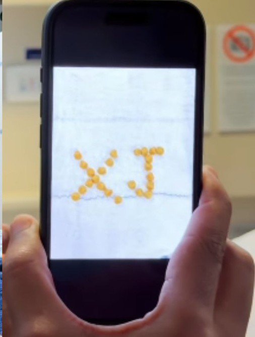 🚨 Veja l Gordão da XJ faz cirurgia para tirar pedras na vesícula e se choca com a quantidade: 'Dava para construir uma casa'