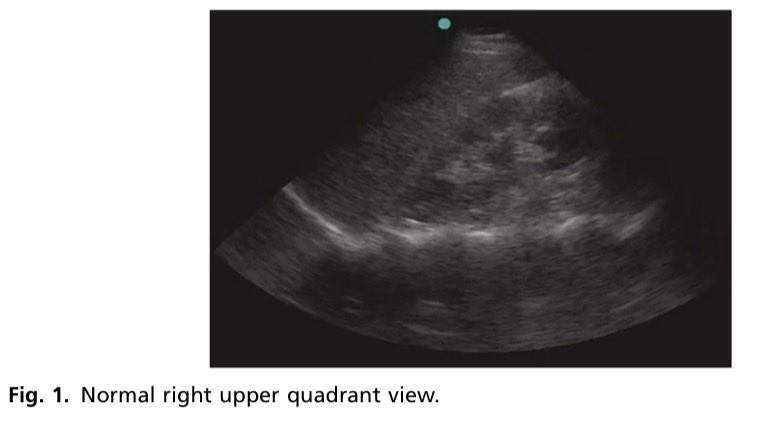 EmergPOCUS's tweet photo. 🧵 #Hilo Cómo hacer el USG #FAST en #Urgencias 

Paso 1. Preparación y equipo

• Transductor baja frecuencia (~3.5 MHz)
• Curvilíneo o phased array (elige el que mejor penetre)
• Ajusta antes de iniciar:
 – Profundidad suficiente
 – Ganancia que permita ver interfaces
• Paciente en decúbito supino