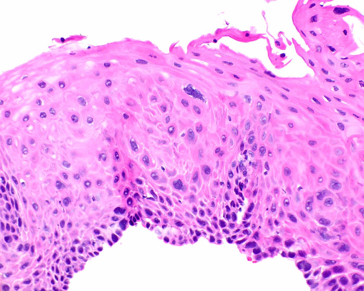 LizMontgomeryMD's tweet image. p53 IHC can help confirm a diagnosis of esophageal squamous dysplasia.  In occasional HPV-associated cases, p16 staining is strongly reactive. This example is probably driven by a TP53 mutation.   Don't expect the full thickness staining typical of glandular dysplasia.