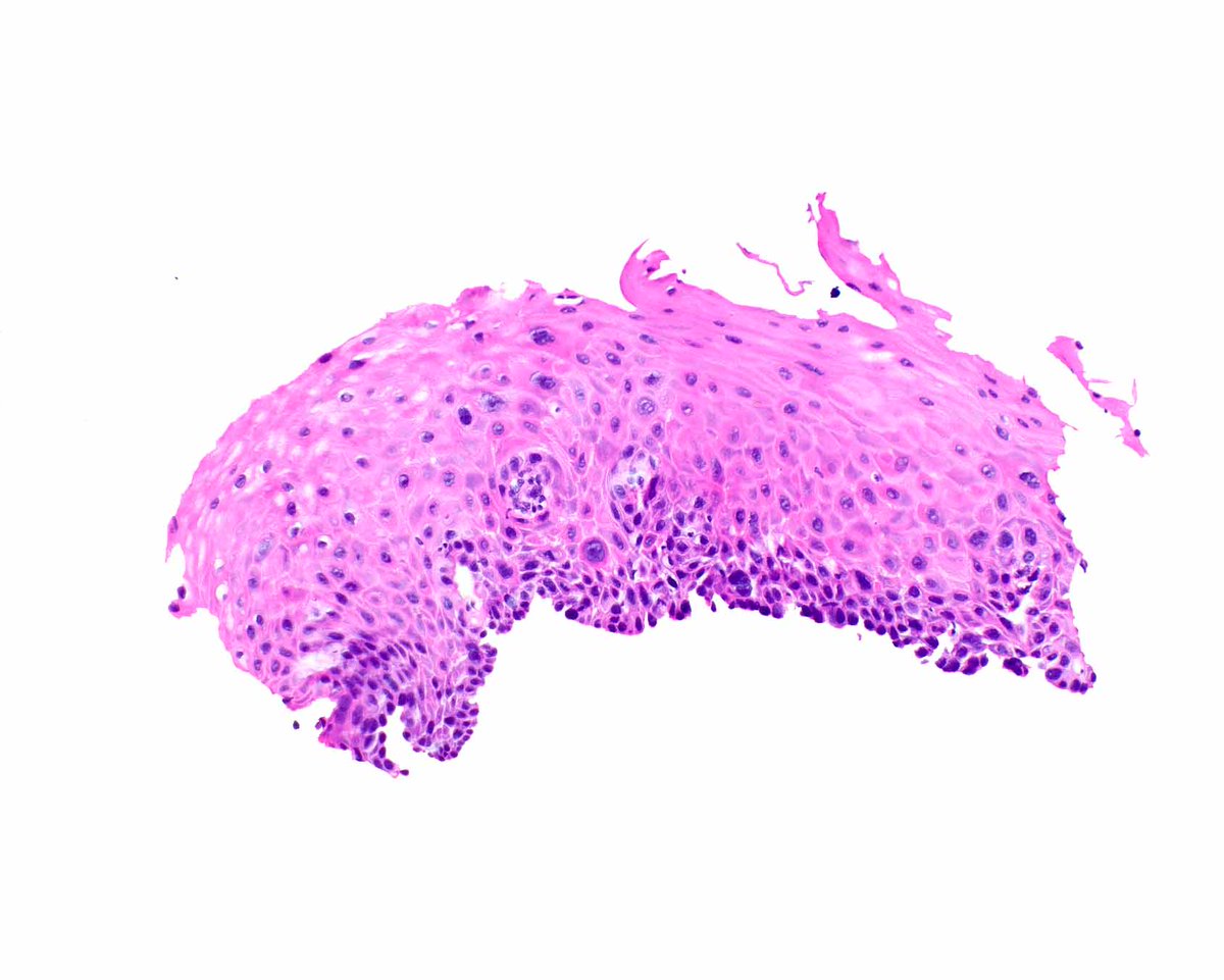 LizMontgomeryMD's tweet image. p53 IHC can help confirm a diagnosis of esophageal squamous dysplasia.  In occasional HPV-associated cases, p16 staining is strongly reactive. This example is probably driven by a TP53 mutation.   Don't expect the full thickness staining typical of glandular dysplasia.
