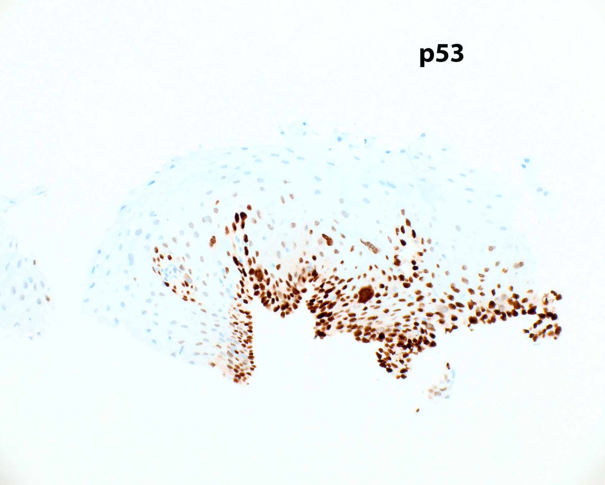 LizMontgomeryMD's tweet image. p53 IHC can help confirm a diagnosis of esophageal squamous dysplasia.  In occasional HPV-associated cases, p16 staining is strongly reactive. This example is probably driven by a TP53 mutation.   Don't expect the full thickness staining typical of glandular dysplasia.