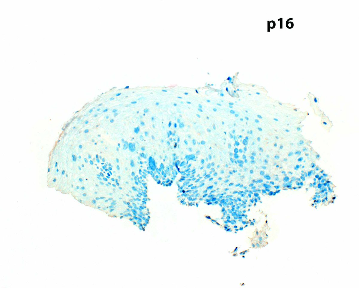 LizMontgomeryMD's tweet image. p53 IHC can help confirm a diagnosis of esophageal squamous dysplasia.  In occasional HPV-associated cases, p16 staining is strongly reactive. This example is probably driven by a TP53 mutation.   Don't expect the full thickness staining typical of glandular dysplasia.