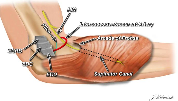 Omid_HopeUni's tweet image. Anatomy of the examined sources of the lateral elbow pain

ECRB—extensor carpi radialis brevis
EDC — extensor digitorum communis
ECU — extensor carpi ulnaris
PIN — posterior interosseous nerve
Plica — synovial lateral plica of the elbow

#elbow #anatomy 
link.springer.com/article/10.100…