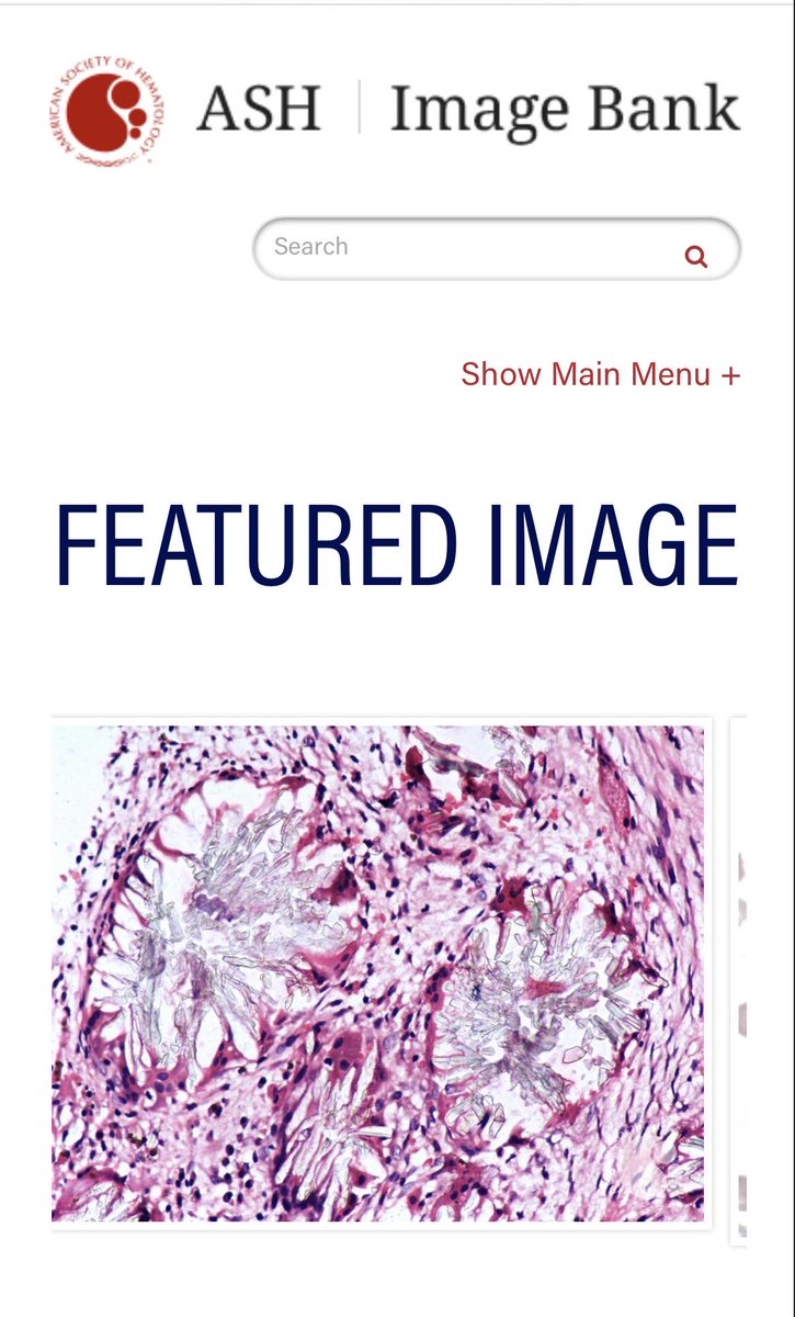 sanamloghavi's tweet image. Dear #hemepath aficionados, we have exciting news from #ASHImageBank 🤩We're using social media &amp;amp; AI to spotlight cases, recognize authors, &amp;amp; teach #hematology with weekly educational posts packed with teaching pearls. Be on the lookout &amp;amp; let's learn together! #PathTwitter