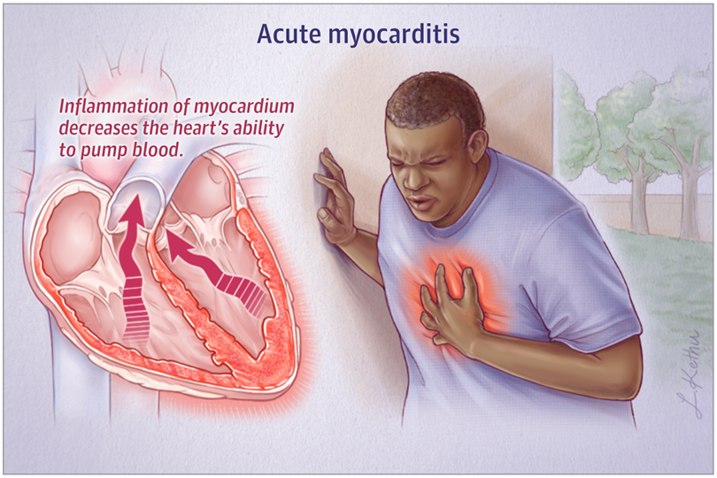 Aller_MD's tweet image. Possible Mechanisms Emerge for Vaccine-Associated Myocarditis jamanetwork.com/journals/jama/…