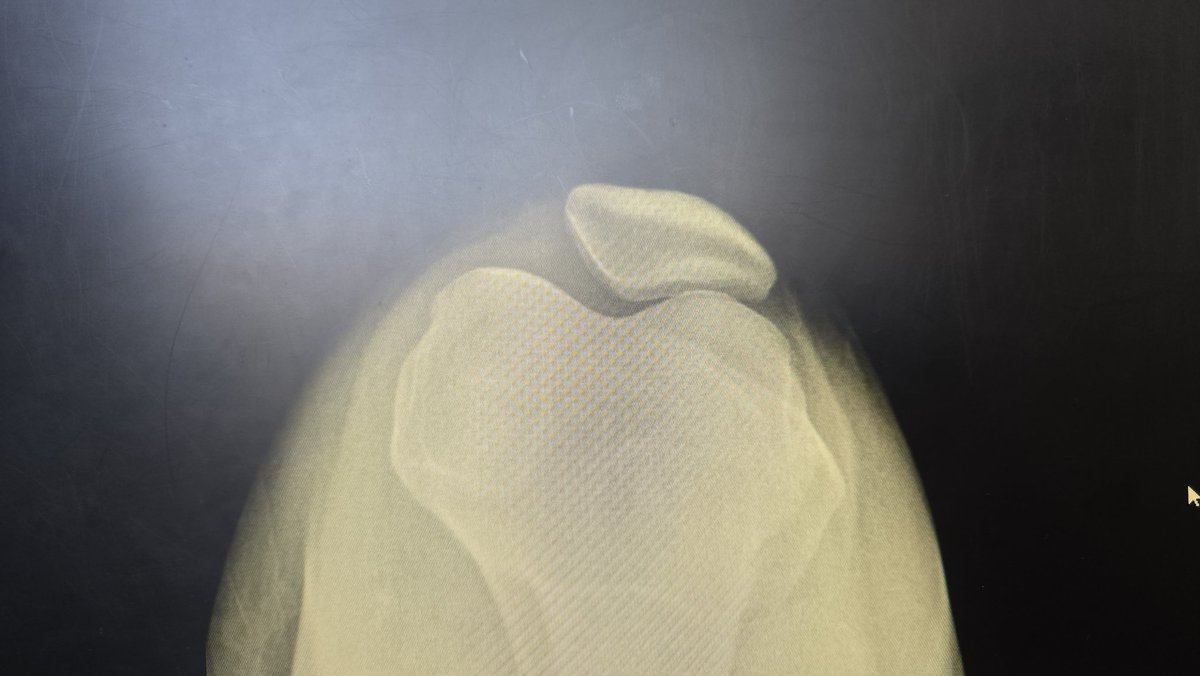 절대...의자에서 양반다리 하지 마세요
의자에 앉았을 때 발이 바닥에 다 닿지 않아 뒤꿈치를 들게 된다면 발받침을 사용하세요
위와 같은 습관이 있다면 종아리, 허벅지 앞쪽 근육을 꾸준히 풀어주세요. 강아지도 아니고 사람 슬개골이 가출할 수도 있습니다
저도 알고 싶지 않았으며....