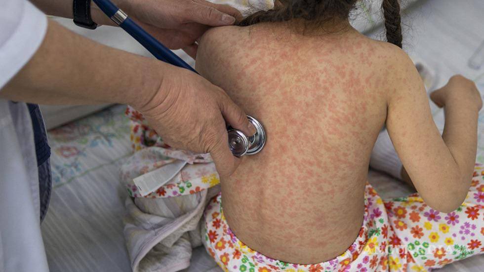 El uso de cubrebocas tiene que volver. El sarampión está de regreso por la negligencia de los gobiernos de MORENA. México necesita urgentemente una estrategia sanitaria nacional. Lo que estamos viendo es una alerta sanitaria que puede escalar rápido. El sarampión es altamente