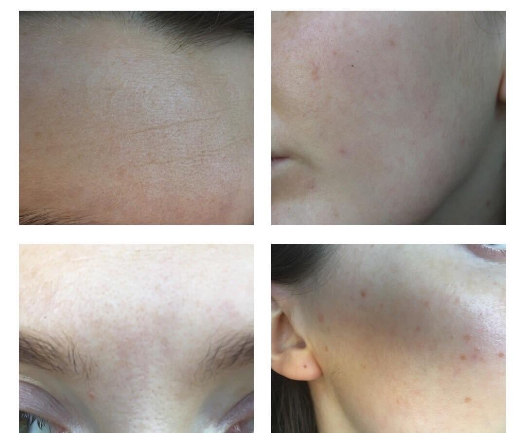 wonla23's tweet image. 여드름, 모낭염, 등으로 고민이신 분들께 추천!!

아젤라산 크림(일명 아젤리아 크림)입니다. 요즘 바이럴 타는 제품들처럼 과대 광고된 게 아니라, 실제로 꾸준히 써본 분들이 입소문 내는 약국템이에요.

아젤라산은 여드름 원인균을 억제하고, 염증을 줄여주며, 각질을 정리해 주는 성분으로…