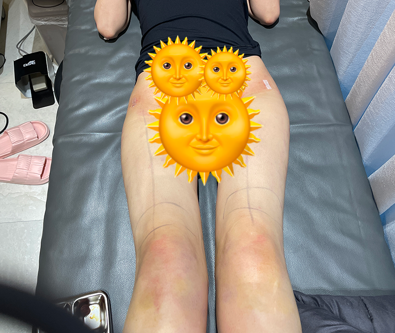 odedendenoden's tweet photo. 太もも（全周・バナナライン・シャネルライン・膝上）の脂肪吸引してきました。上半身と同じくディライトです。上半身と太ももの同日施術は🙅で最低1ヶ月空ける必要があったのでこのタイミングに。むくみが辛いのでDT的に分けてよかったです

写真はDT1日目 https://t.co/cKqqWNRmm9