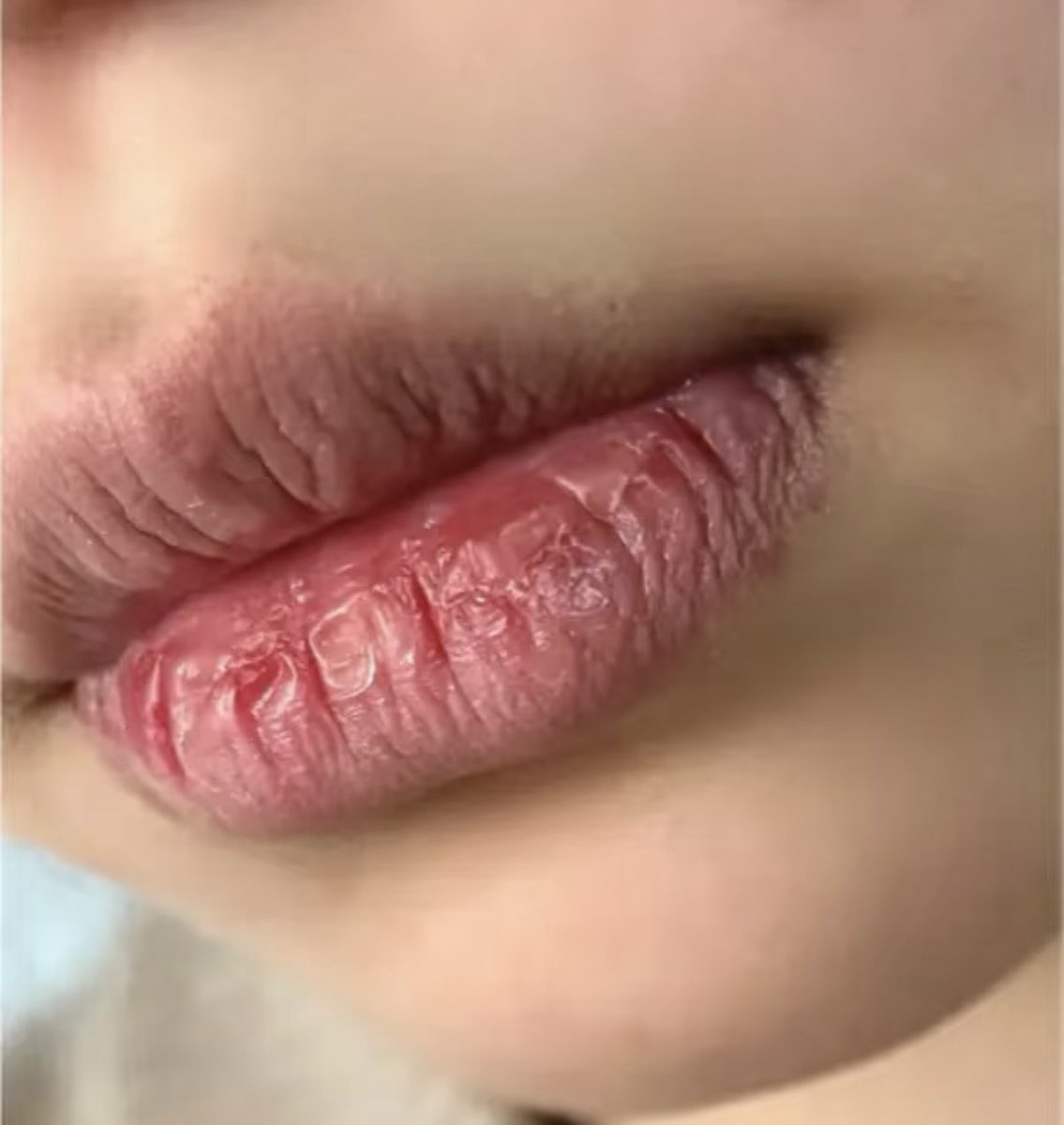 tonett_i's tweet image. 冬は特に唇こうなる率高くて萎える……みんなどうやってケアしてるんですか……