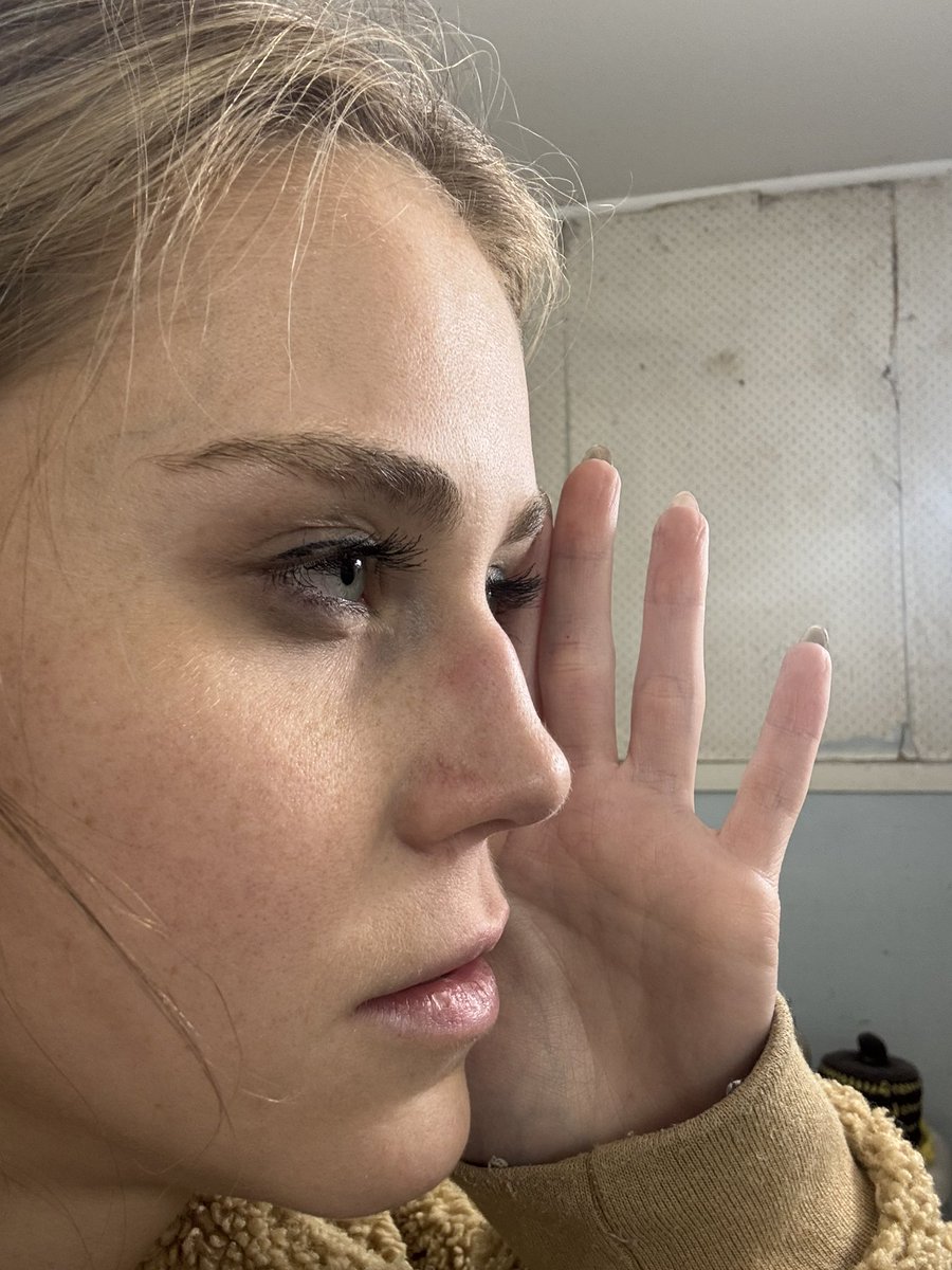 Nikki_Shieldss's tweet photo. I got punched in the nose and literally got back the nose I paid to get rid of for FREE https://t.co/PqCUnGbTp9