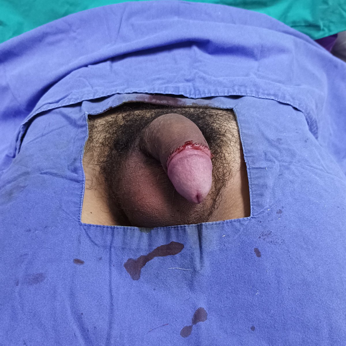 น้องชายไม่มีปัญหาก็ ขลิบ ได้💉‼️
ด้วยเทคนิค Sleeve Technique 

✨แผลสวย เลือกระดับการตัดหนังได้✨

BY :  นพ.กริช ออประเสริฐ ว.57344 👨🏻‍⚕️
" แพทย์เฉพาะทางศัลยศาสตร์ยูโร "

10.02.69 #ทำที่คลินิก