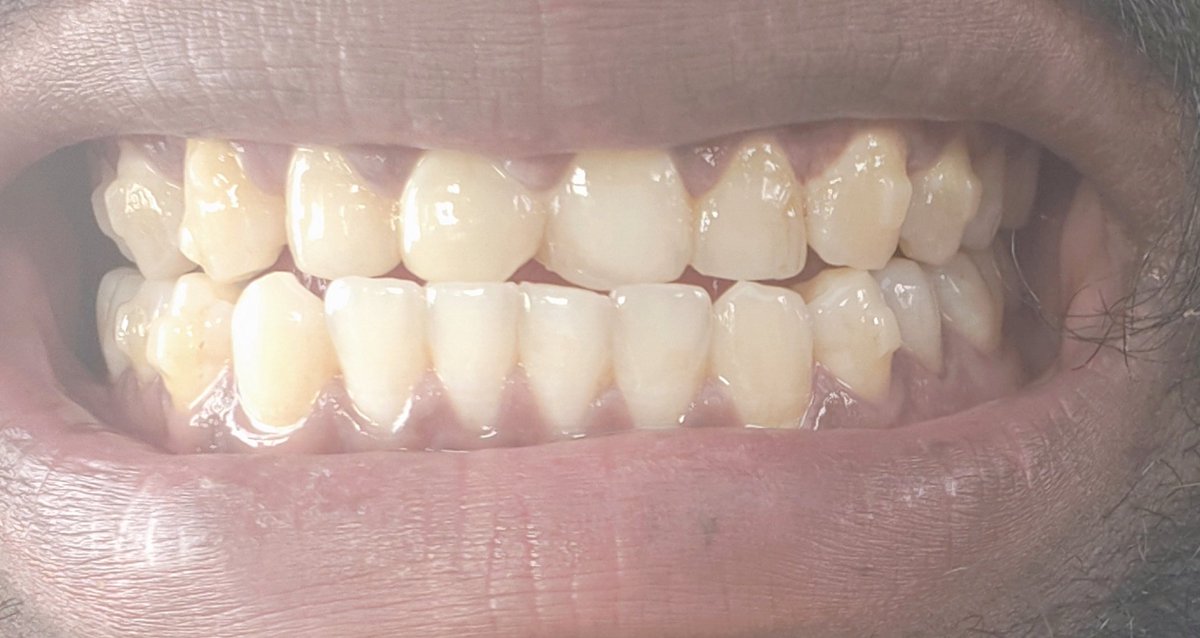 Udayzone909's tweet image. 721 DAYS &amp;amp; my teeth are still NOT set. @ToothsiOfficial @makeo_official, your 1-year promise was a lie. I’m done with "booster aligners" &amp;amp; excuses.
Issue my FULL REFUND now or my next move is legal action via NCDRC. Stop ghosting!
#ToothsiScam #ConsumerRights @ncdrcindia