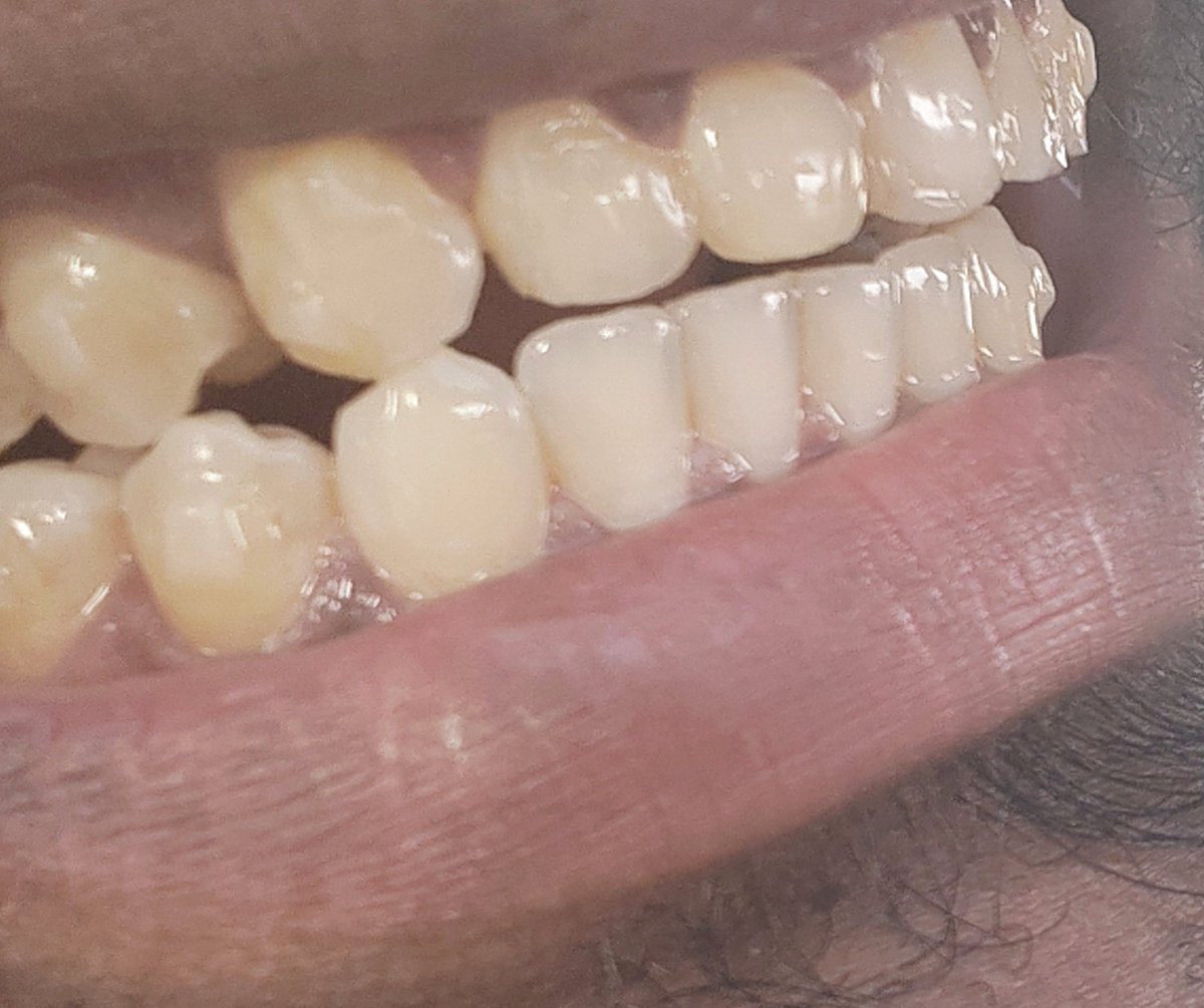 Udayzone909's tweet image. 721 DAYS &amp;amp; my teeth are still NOT set. @ToothsiOfficial @makeo_official, your 1-year promise was a lie. I’m done with "booster aligners" &amp;amp; excuses.
Issue my FULL REFUND now or my next move is legal action via NCDRC. Stop ghosting!
#ToothsiScam #ConsumerRights @ncdrcindia