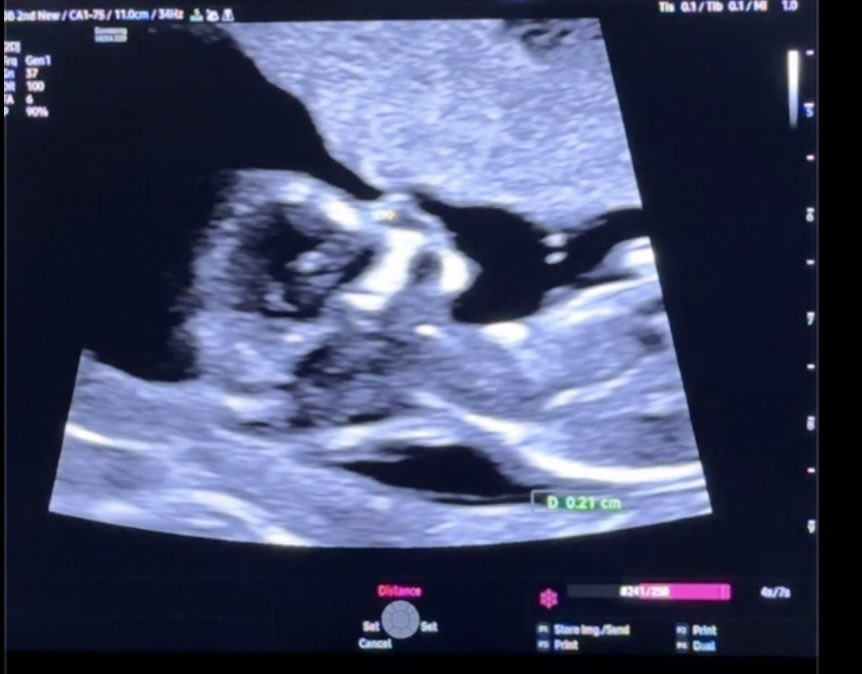 TeslianGen2's tweet image. 축하해주십시오!!!
둘째 딸입니다!!!!!!!!!!!🎉🎉🎉
아들 둘 될 뻔 했는데 갓차 성공했습니다!!!!
아들+딸 조합  기분 최고네요!!
대한민국 출산율에 저도 기여합니다🫡