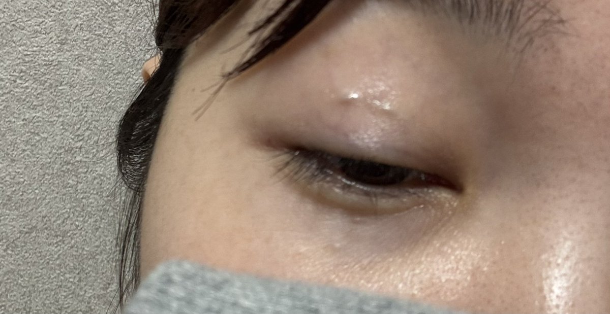 _GANMEN_BUSU's tweet photo. 最近、二重手術したけど、これ正解なん？？？
術後2週間ぐらい。
2週間後予約してるけど、それまでにマシになるんかな
めっちゃ片目側糸の場所分かるんやけど。 https://t.co/4YPAINGkof