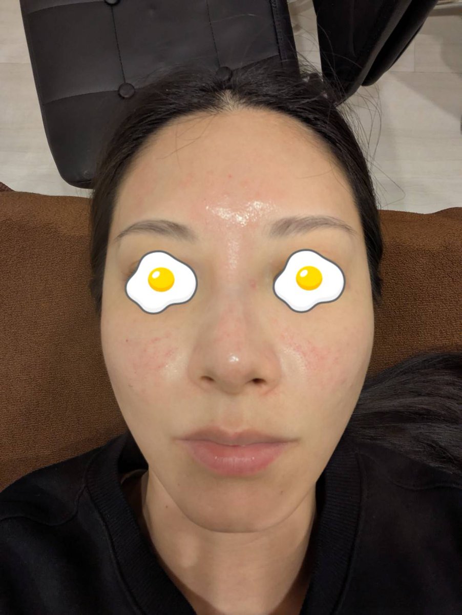 ジュベルック3回目打ってきた💉🫧
カウンセリングで1回目の施術前と今回施術前の写真を比べて見たけれど、頬の毛穴が浅くなって改善してた😭毎日見ているから気づかなかったというかジュベルック効果ない？とまで思ってた笑
写真欲しくて依頼したけれど、情報保護観点で渡せないとのこと😅