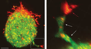 Quomi8's tweet photo. Ovarian cancer cells hijack mesothelial cells in abdominal fluid to form invasive, chemo-resistant clusters.
Read more on https://t.co/BmBFDDH8xP
#quomi #OvarianCancer #CancerResearch #oncology #MedicalBreakthrough #ScienceAdvances #CancerTreatment #developmentinmedicine https://t.co/bejwsRCO1M