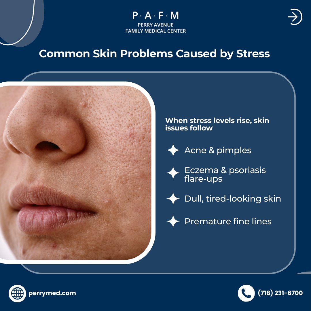 PerryMed18's tweet image. Stress can trigger acne, inflammation, and early aging but you can take control. 

Manage stress, follow a proper skincare routine, and get expert dermatology care for healthier skin. Start today: perrymed.com/services/derma…

#ClearSkinGoals #HealthySkin #PerryMed