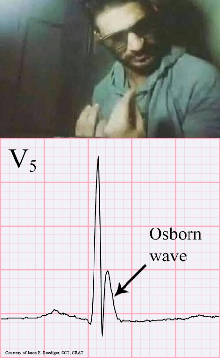 TrackYourHeart's tweet photo. The Osborn wave is classically associated with:
A. Hyperkalemia
B. Hypothermia
C. Digitalis toxicity
D. WPW syndrome https://t.co/QzAsS8OEf9