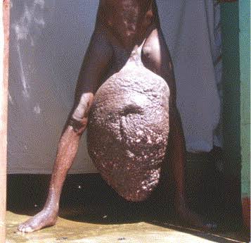 the_beardedsina's tweet image. This is spread by Mosquitoes and not spiritual. 

The Worms that spread it are carried by Mosquitoes and spread by mosquito bites