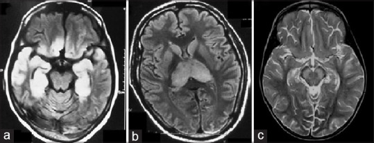 DocNavarrow's tweet photo. MRI clue for acute viral encephalitis 

🅰️ Medial temporal + orbitofrontal → think HSV

🅱️Bilateral thalami ± basal ganglia → Japanese encephalitis

©️Substantia nigra / brainstem predilection → West Nile virus

https://t.co/8lBoU2rJg2 https://t.co/j2CHVZ7scz