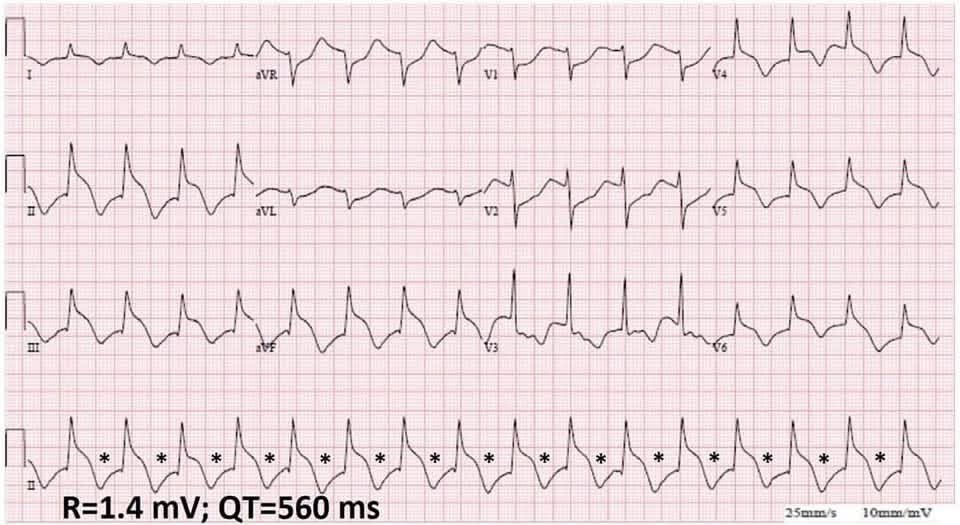 hemo_shk's tweet image. #ECG
#EKG

What is the name of this sign?