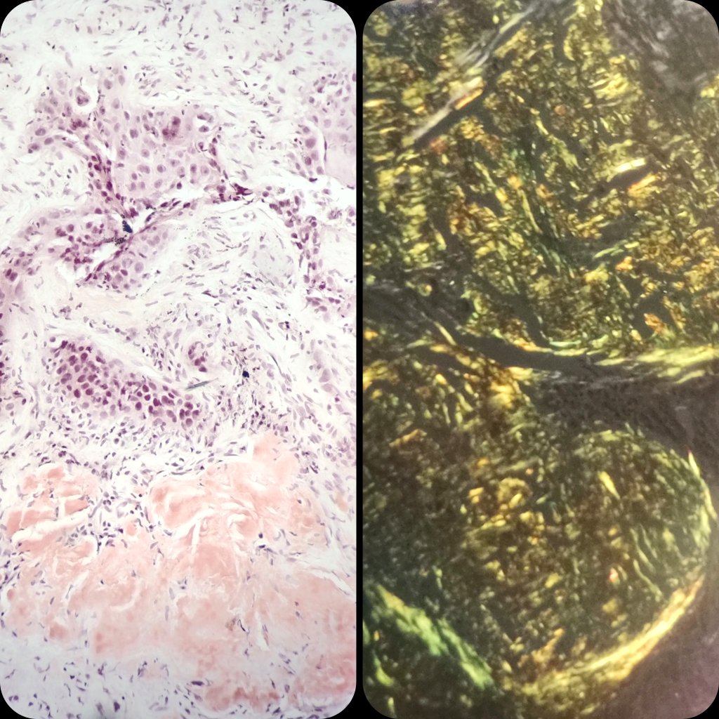 🫁 Lung Nodule.  Core needle biopsy.
🔬 Squamous Cell Carcinoma ➕ Amyloidosis.
➕ p40.
🍏 Congo Red.

#LungPath #LungCancer