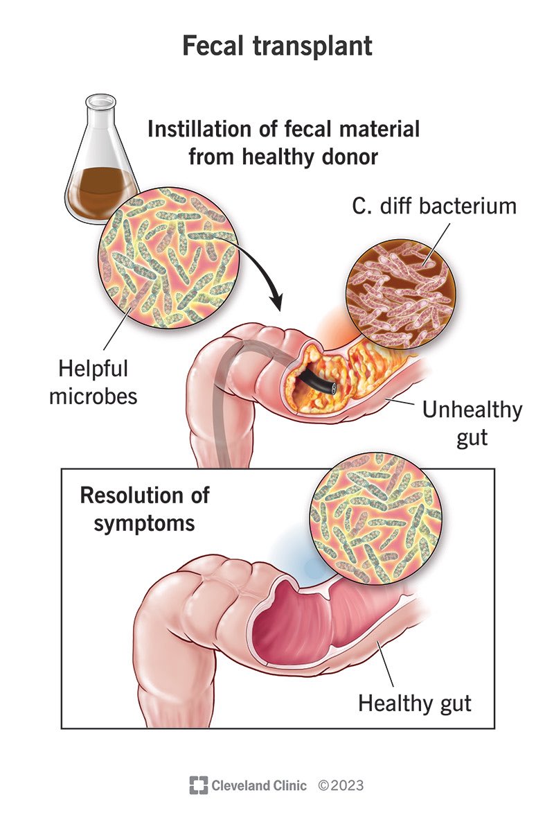 AymanAlatas's tweet photo. Transplantasi Feses: Bisa menyelamatkan Nyawa Manusia?!

Transplantasi Mikrobiota Feses (FMT) bukan sekadar tren, melainkan prosedur medis krusial yang mampu menyembuhkan infeksi mematikan Clostridioides difficile yang kebal antibiotik dengan tingkat keberhasilan mencapai 90%. Melalui transfer mikroba "sehat" dari donor ke usus pasien, kita tidak hanya memulihkan ekosistem bakteri yang rusak, tetapi juga membuka pintu penyembuhan bagi penyakit autoimun, obesitas, hingga gangguan metabolisme dengan cara menyeimbangkan kembali mikrobioma usus yang menjadi pusat pertahanan tubuh kita, mungkin dikemudian hari tindakan ini akan mulai banyak dilakukan.

dr. Ayman Alatas SpMK