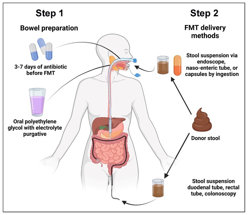 Transplantasi Feses: Bisa menyelamatkan Nyawa Manusia?!

Transplantasi Mikrobiota Feses (FMT) bukan sekadar tren, melainkan prosedur medis krusial yang mampu menyembuhkan infeksi mematikan Clostridioides difficile yang kebal antibiotik dengan tingkat keberhasilan mencapai 90%.