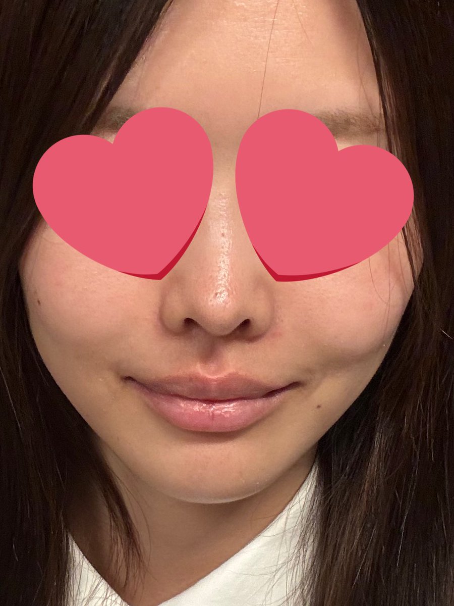 stayyactive's tweet photo. ・2週間

腫れは落ち着き、内出血も完全に消え、表情も自然になったためマスクなしで生活できるようになりました。
事前に説明を受けていた通り左右差が出ました。私の場合は左側のみボリューム感がやや強く、触れると少し盛り上がりを感じます。
ただ、見た目ではほとんど気にならない程度です。 https://t.co/rrCFwAG63q
