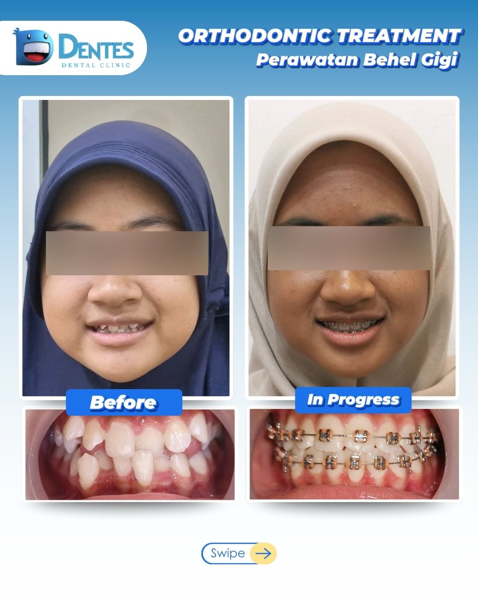 Progress perawatan behel gigi