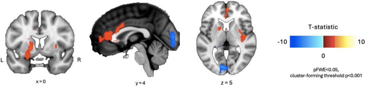 vipintukur's tweet photo. New brain-imaging research suggests that #LongCOVID may involve immune and blood-vessel related changes in the brain.

➡️ These changes may affect how the brain produces and uses energy.

➡️ Researchers used advanced imaging methods to study people with post-COVID symptoms such as fatigue and brain fog.

➡️ Results suggest altered brain metabolism and vascular function, which may explain persistent symptoms. 1/