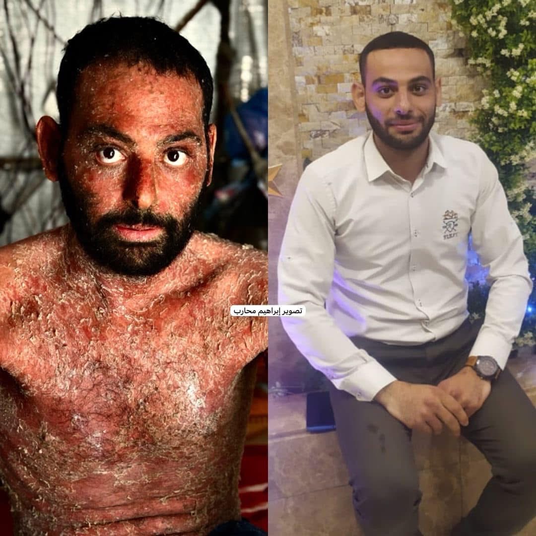 Gazzeli İbrahim için acil yardım çağrısı! 🚨

Nadir görülen Pemphigus Vulgaris hastalığı nedeniyle vücudu tükenmiş durumda. Bağışıklık sistemi çöktü ve durumu her geçen gün ağırlaşıyor.

İbrahim’in tek kurtuluş yolu yurt dışında tedavi görmek.

Lütfen paylaşın, İbrahim’in