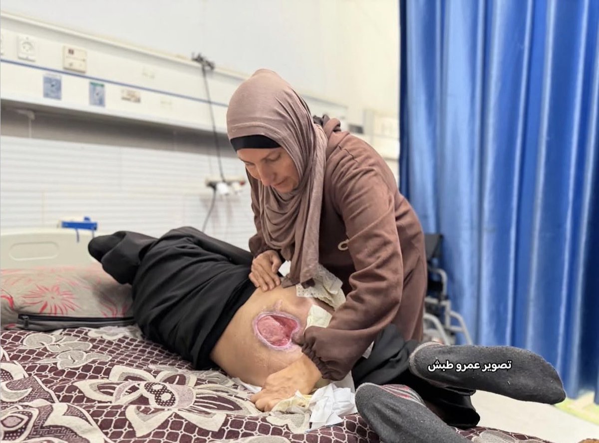 amrtabashh's tweet photo. The child, Ibrahim Qweider (14 years old), is suffering from severe and deep pressure ulcers that have spread across various parts of his body, including sensitive areas, leading
to a critical deterioration in his health condition. #Gaza #palestine #savegazachildren https://t.co/ESKiFwa6GU