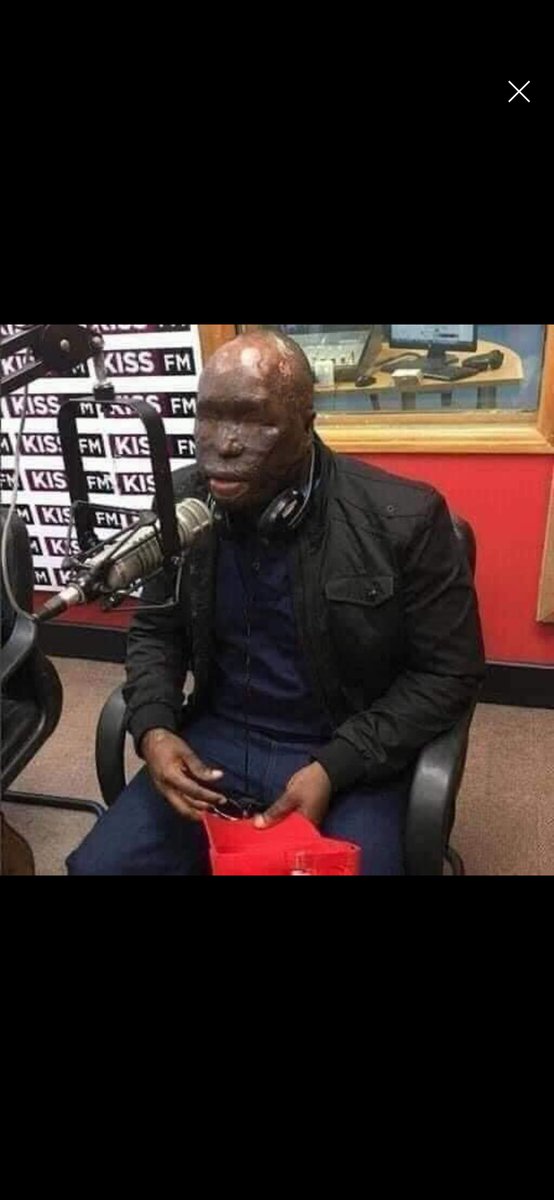 HE WAS NOT BORN BLIND, HIS WIFE DID THIS TO HIM

This is Inspector Dan Matakaya, a 31 year old police officer. Mr Dan was not born with this frightening appearance. What you see is the result of a normal argument he had with his wife.
One day, Dan and his wife had an argument