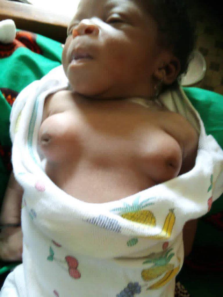 Do not panic when you notice this in your new born. See your doctor quickly. But note that it could be physiological due to maternal hormones.