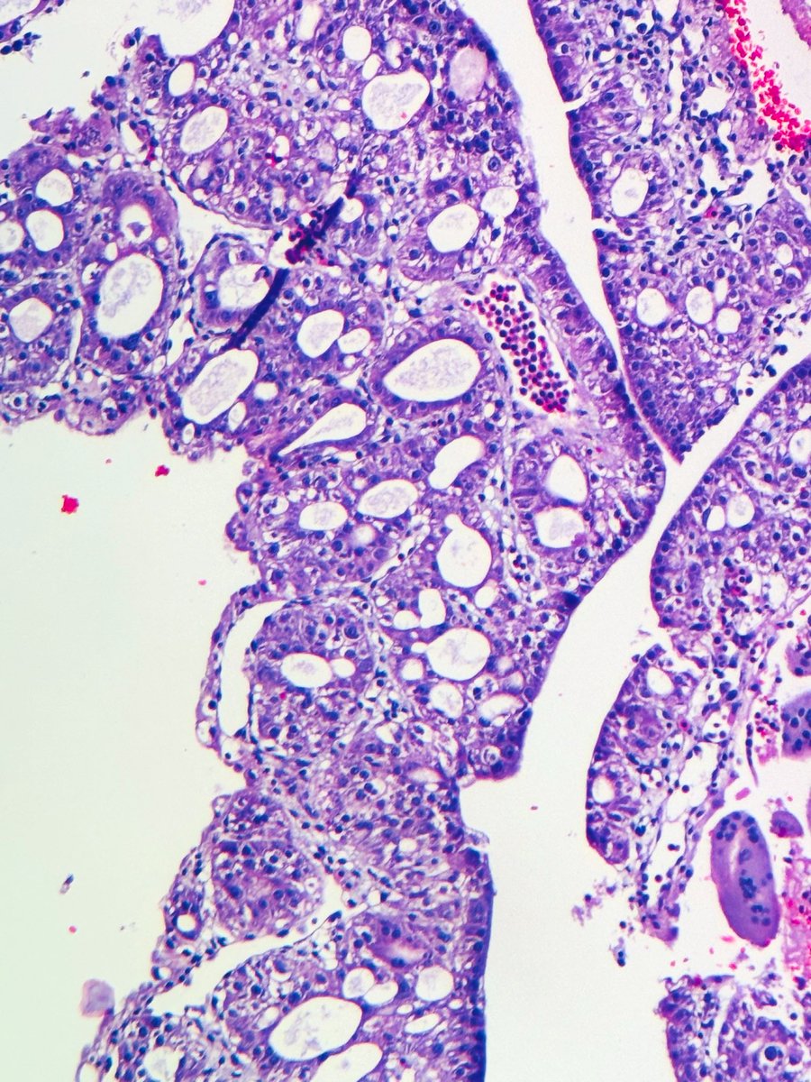 Janiranavarro's tweet photo. Ectopic pregnancy with fetal parts and yolk sac remnant (or simply yolk sac), Pic 1

It is not common to see a yolk sac in a POC specimen or even in ectopic pregnancy. It looks concerning, but once you see one, you'll recognize it faster next time.

Yolk sac, high power (Pic 2)

For the best educational thread on yolk sac, check @leon_metlay's post: https://t.co/wNu2SXpYqe

Another yolk sac post from Dr. Kaur's ISGYP presentation: https://t.co/x8H67pzXBZ

#everydayGYN #PathX #pathtwitter